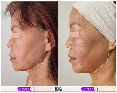 Hifu Treatment Sydney Your Ultimate Pathway To Ageless Beauty
