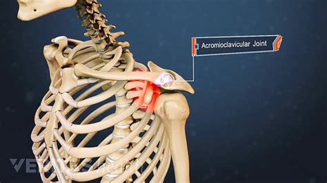A Visual Guide To Shoulder Ac Joint Arthritis