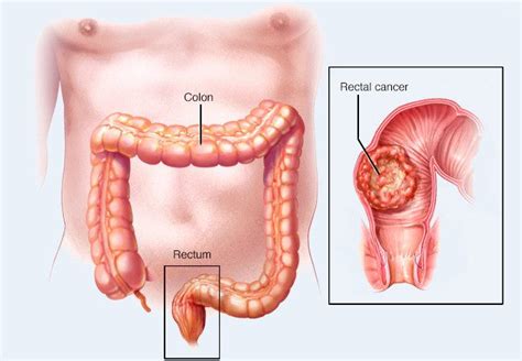 Rectal Cancer Diagnosis And Treatments From Top Cancer Hospital