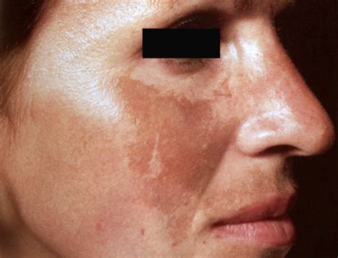 Melasma Causes Treatment Affects Skin Of Color Society