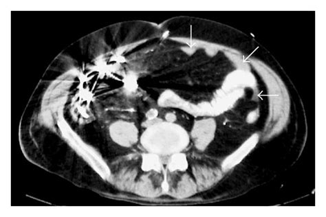Abdominal Ct Scan At The Level Of The Iliac Crests Demonstrates Dense