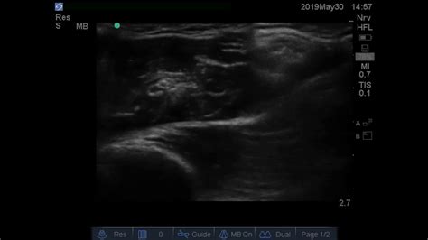 Ultrasound Guided Axillary Brachial Plexus Block Youtube
