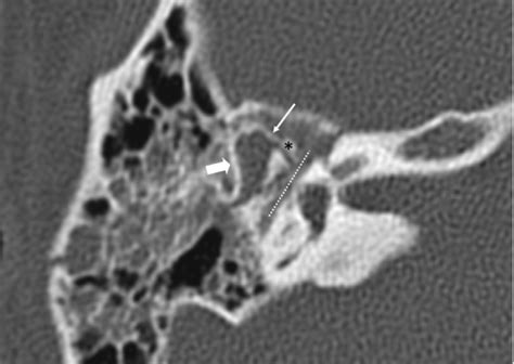 Original Axial Ct Image At The Level Of The Malleo Incudal Complex The