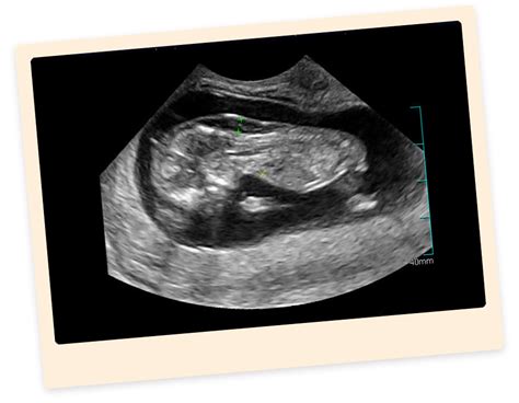 Welche risiken gibt es bei einer nackenfaltenmessung? Schwangerschaft | Mein Frauenarzt Freilassing