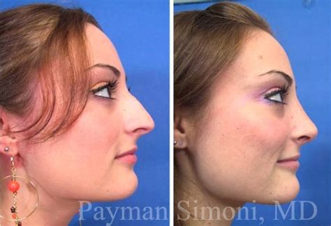 Rhinoplasty Before And After Photos Beverly Hills Rhinoplasty Before