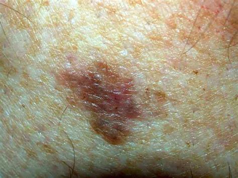 Melanoma Skin Cancer On Arm