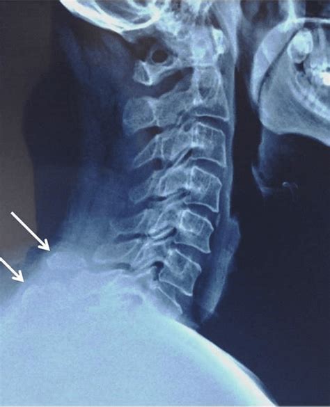 C6 And C7 Spinous Process Fracture In The Lateral Radiographs