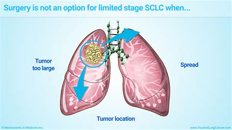 Slide Show Treatment And Management Of Small Cell Lung Cancer Sclc