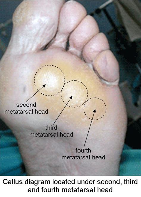 Foot Callus Anatomy