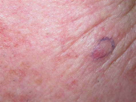 It may spread quickly to surrounding tissues, nearby lymph nodes, or more distant parts of the body. ACD A-Z of Skin - Merkel cell carcinoma