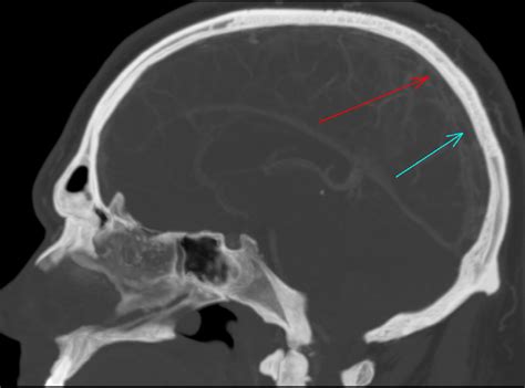 Cureus Cerebral Venous Sinus Thrombosis With Bilateral Abducens Palsy