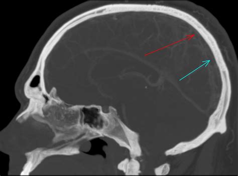 Cerebral Venous Sinus Thrombosis Mrv Local Thrombolysis For Severe