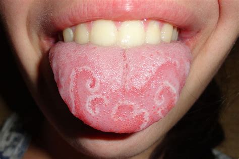 Small Big Sore Red Spots On Tongue Cause And Meaning American Celiac