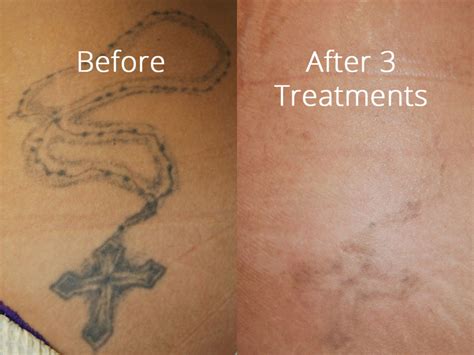 You can pick any word that holds deep personal meaning to you and get it tattooed on the upper breast. Laser Tattoo Removal | Salmon Creek Plastic Surgery
