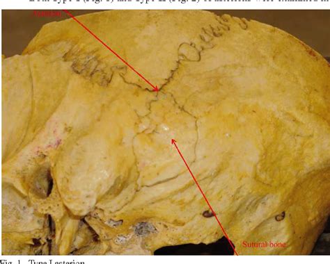 Figure 1 From Incidence Of Sutural Bones At Asterion In Adults Indians