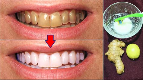 How To Get Rid Of White Spots On Teeth Naturally Mager Guys