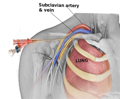 Central Venous Access Of The Subclavian Vein Article
