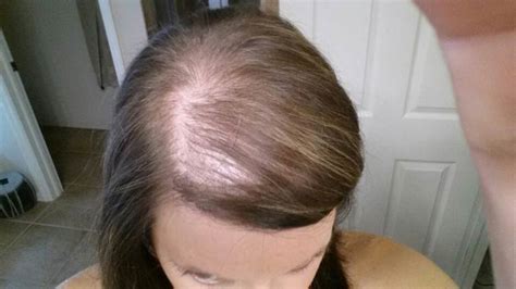 Top Image Hair Loss After Pregnancy Thptnganamst Edu Vn