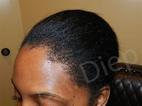 Many black men suffering from receding hairline. Hairline Lowering vs. Hair Transplant Surgery | Hair ...