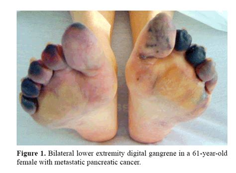 Cancers that start near the head of the pancreas can block the bile duct, preventing bile from reaching the intestines, where it helps break down fats and eventually leaves the body in the. Catastrophic Arteriovenous Thromboembolism as Initial ...