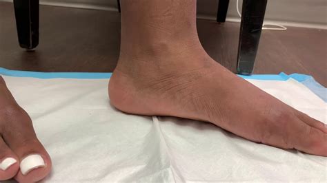 PERFORMED MINIMALLY INVASIVE HYPROCURE SURGERY FOR FLAT FEET YouTube