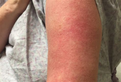 New Treatment Shows Promise For Patients With Rare Dermatologic Disease