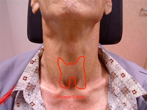 Thyroid Cancer Patient
