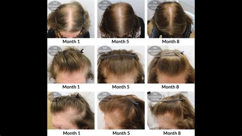 Beauty Tips For How To Grow Hair On Forehead மேல் நெற்றியில் உடனே
