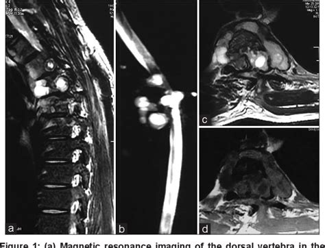 Figure 1 From Hydatid Cyst Of Dorsal Spine Masquerading As Tubercular