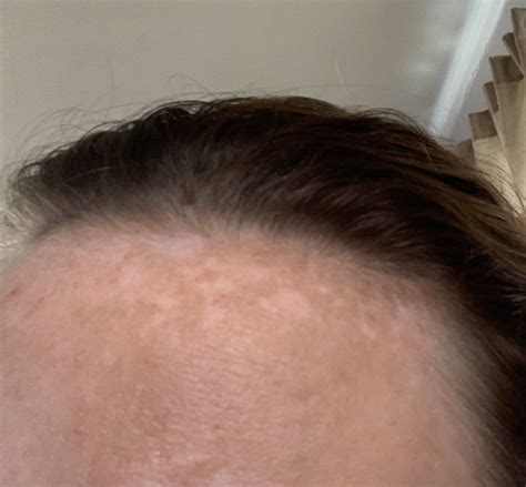 Skin Concerns Looking For Advice On How To Minimize The Appearance Of