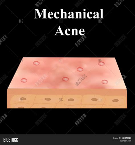 Cyst Acne Acne On Image And Photo Free Trial Bigstock