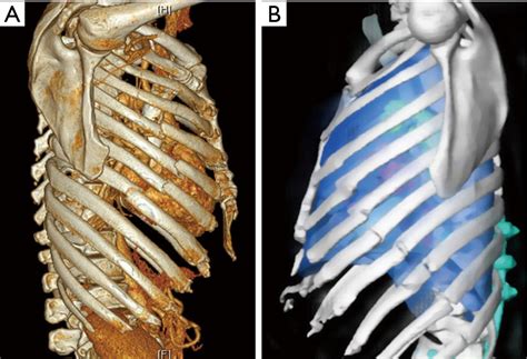 Rib Cage Wall Muscles Thorax Anatomy Wall Cavity Organs