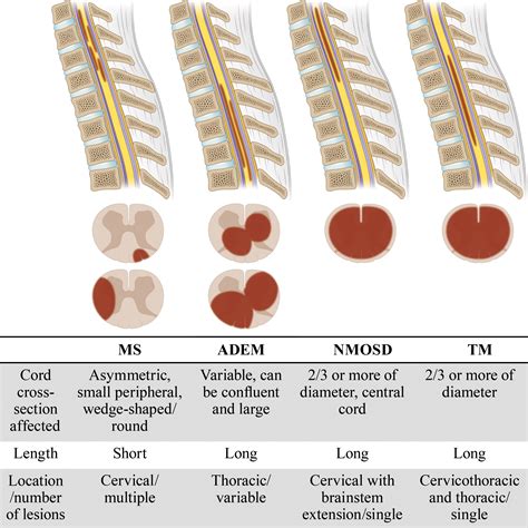 Diagnostic Approach To Intrinsic Abnormality Of Spinal Cord Signal