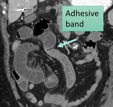 Abdominal Adhesions Radiology Reference Article Radiopaedia Org