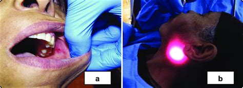 Clinical Photographs Of A Ductal Orifice Dilatation B Visualization