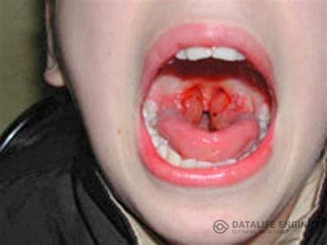 A gum abscess, (also called a periodontal abscess) is usually caused by an infection in the space between the tooth and gum. Diseases of the teeth and gums: Abscesses and cellulitis