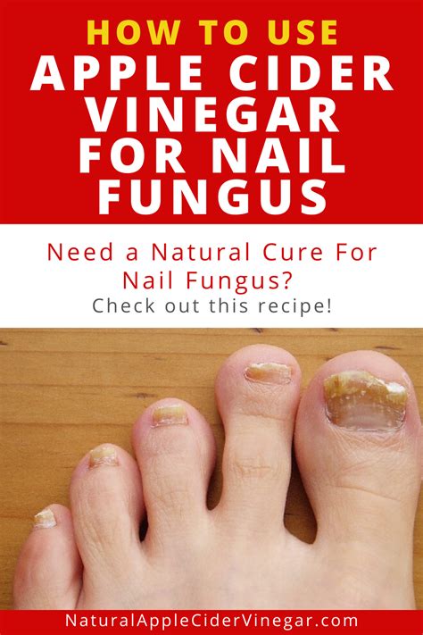 How To Use Apple Cider Vinegar For Nail Fungus All Natural Home