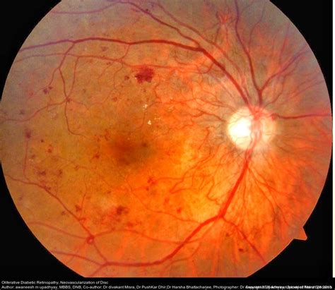 Diabetic Retinopathy Annan Retina Eye Center In Houston Texas