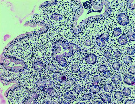 Histopathological Picture Of Gut Biopsy Celiac Disease Download