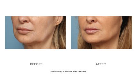 Kybella® Before And After Photos Behr Laser And Skin Care Center