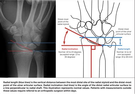 Buckle Greenstick Fracture Of The Distal Radius Sports Medicine Review
