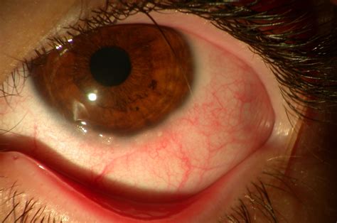 Vernal Keratoconjunctivitis Vkc Ocular