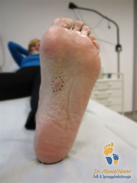 Morbus Ledderhose Die Krankheit Mit Knoten An Der Fußsohle