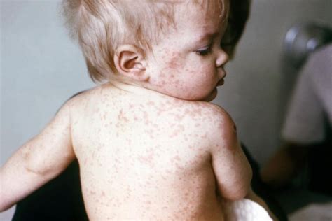 Cdc Urges Measles Vaccination Before Summer Travel Season