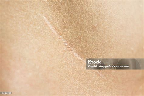 Closeup Beautiful Surgical Scar On The Skin After Appendectomy Stock