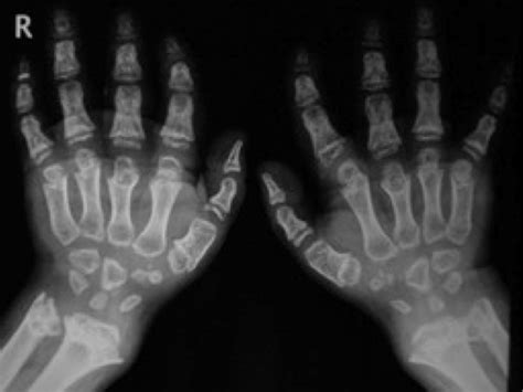 Bone Of Contention Can Wrist X Rays Really Reveal The Age Of People