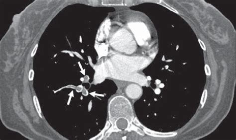 Pulmonary Ct Angiography Image In 43 Year Old Woman Shows Acute