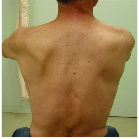 Atrophy Of The Left Infraspinatus Muscle Caused By Suprascapular