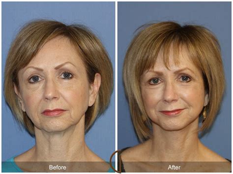 Facelift Fifties Before And After Photos Patient 27 Dr Kevin Sadati