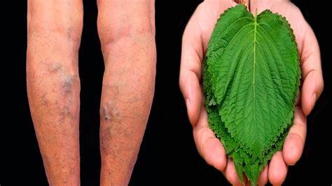 Get Rid Of Varicose Veins Very Quickly How To Treat Varicose Veins